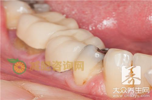 牙齿烟渍怎么去除效果好？