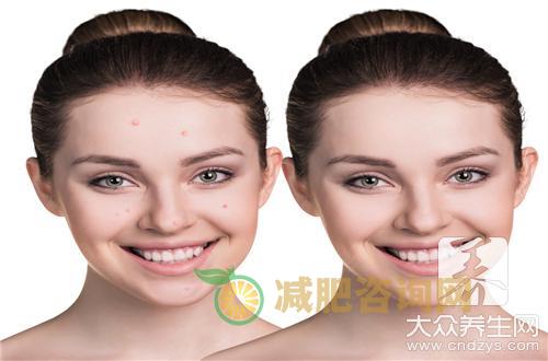 穿凿性毛囊炎是怎么回事？