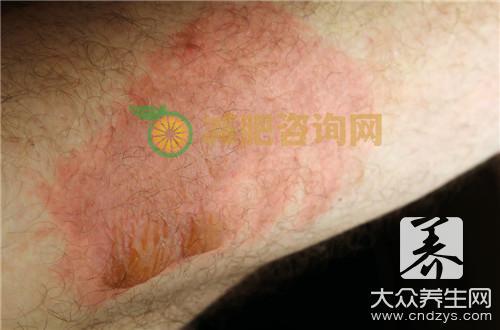 患上皮肤病怎么治呢？
