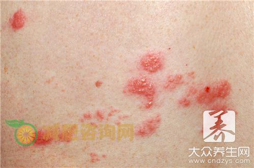 带状疱疹后遗神经痛中医治疗，治愈率高