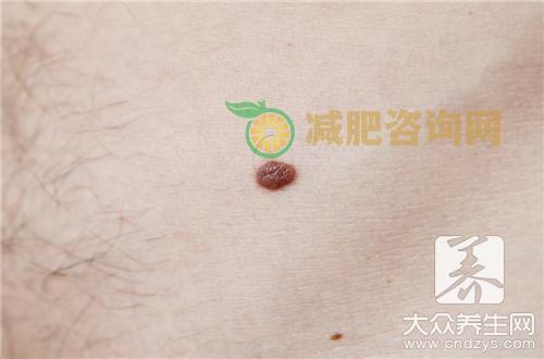毛囊炎痘痘如何治疗？