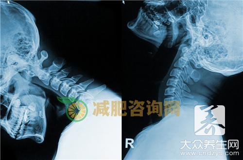 颈椎动脉斑块怎么办
