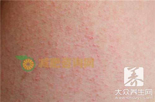 季节性皮炎如何治疗才好？ 