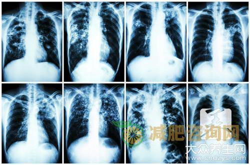 肺结节病的治疗方法有哪些？