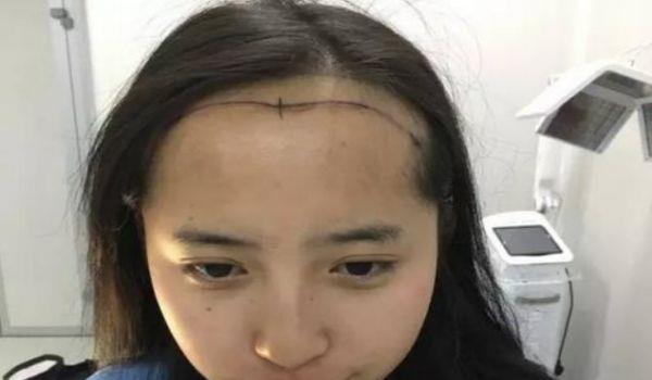 额头太大怎么办呢 为什么有的人额头比较大呢