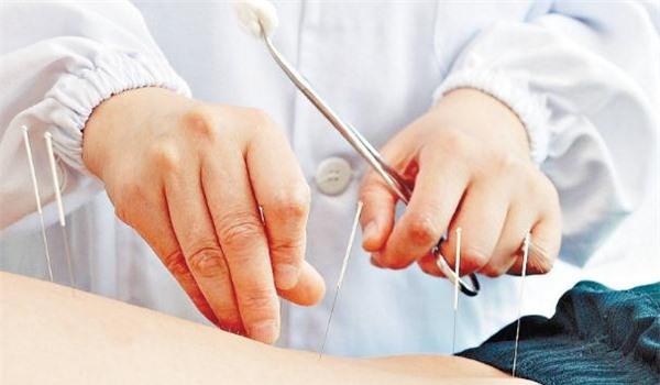 经期可以针灸减肥吗 针灸减肥会导致月经推迟吗